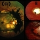 Macular Staphyloma